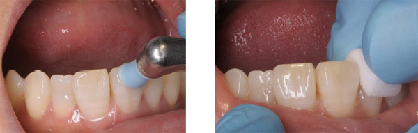 ホワイトニング部位の歯垢、ステイン除去