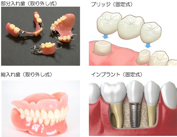 部分入れ歯（取り外し式）、ブリッジ（固定式）、総入れ歯（取り外し式）、インプラント（固定式）