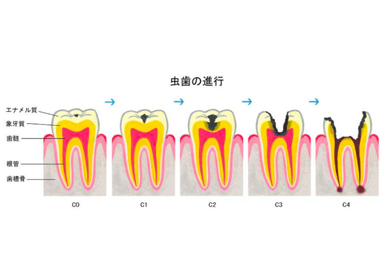 虫歯の進行段階