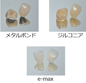 クラウンの費用