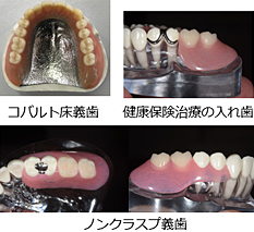 入れ歯の費用