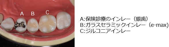 銀歯以外の詰め物や被せ物
