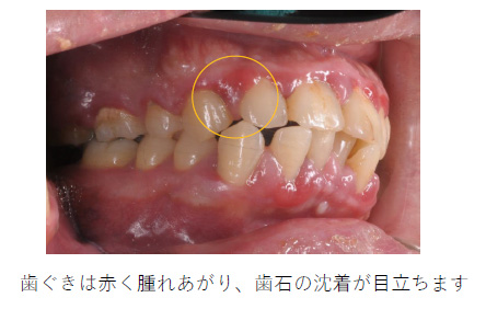 歯周炎に罹患したお口の中
