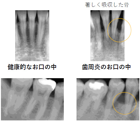 著しく吸収した骨