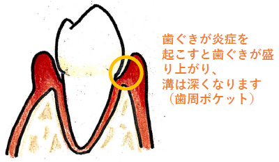 歯肉炎を起こした歯茎