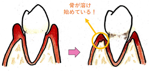 歯肉炎と歯周炎